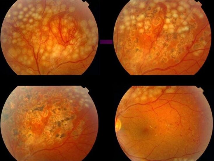 Retinopatía por hipertensión